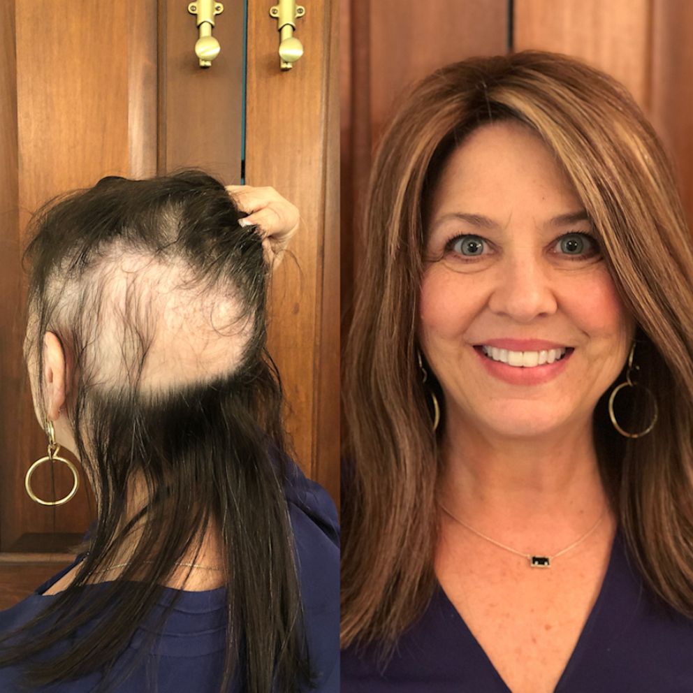 Hair toppers are hair solutions for women with thinning hair