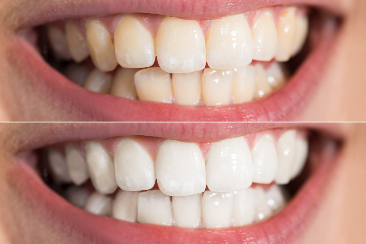 Close-up Detail Of Person Teeth Showing Before And After Whitening 