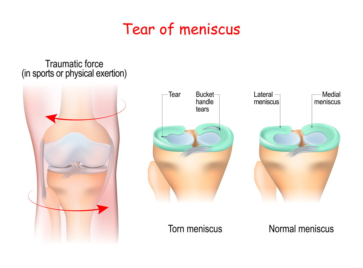 tear of a meniscus is a rupturing of one or more of the fibrocartilage strips in the knee. Human Joint, and Traumatic force in sports or physical exertion. Torn meniscus.