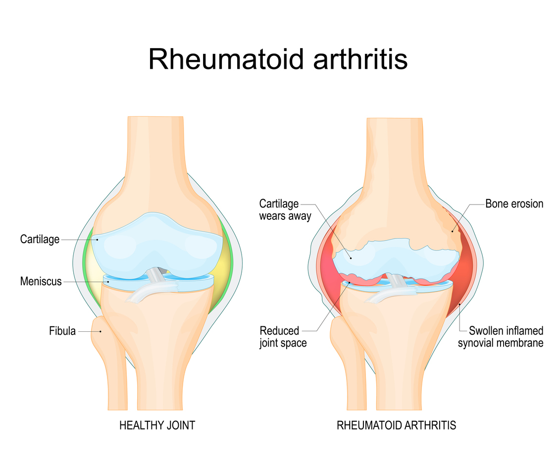 Rheumatoid arthritis. A comparison between a healthy knee and joint with Bone erosion, Cartilage wears, Reduced joint space and Swollen inflamed synovial membrane. Vector illustration with labels. diagnostic images to aid patient and doctor