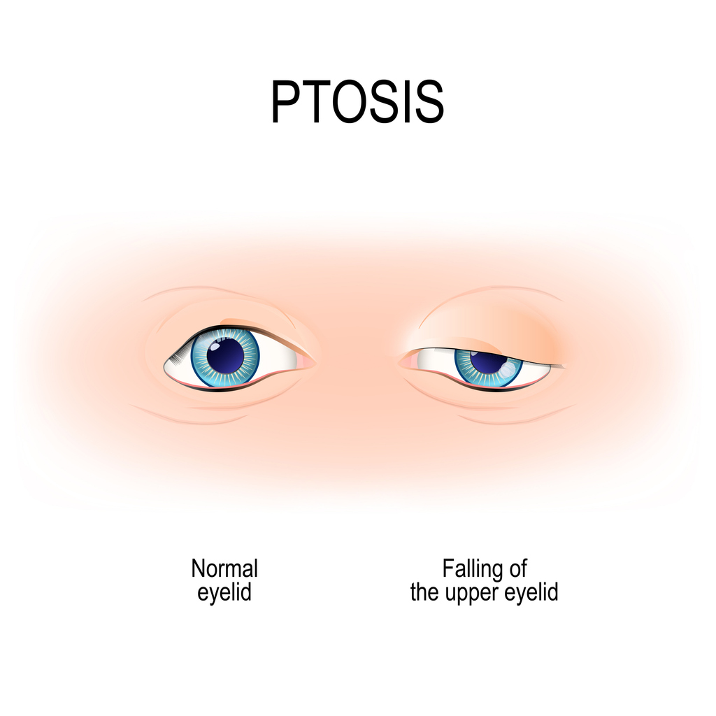 Ptosis is a drooping of the upper eyelid. lazy eye. this disorder is the result of allergies or muscle weakness, it can also be a symptom of thyroid or eye disease. 