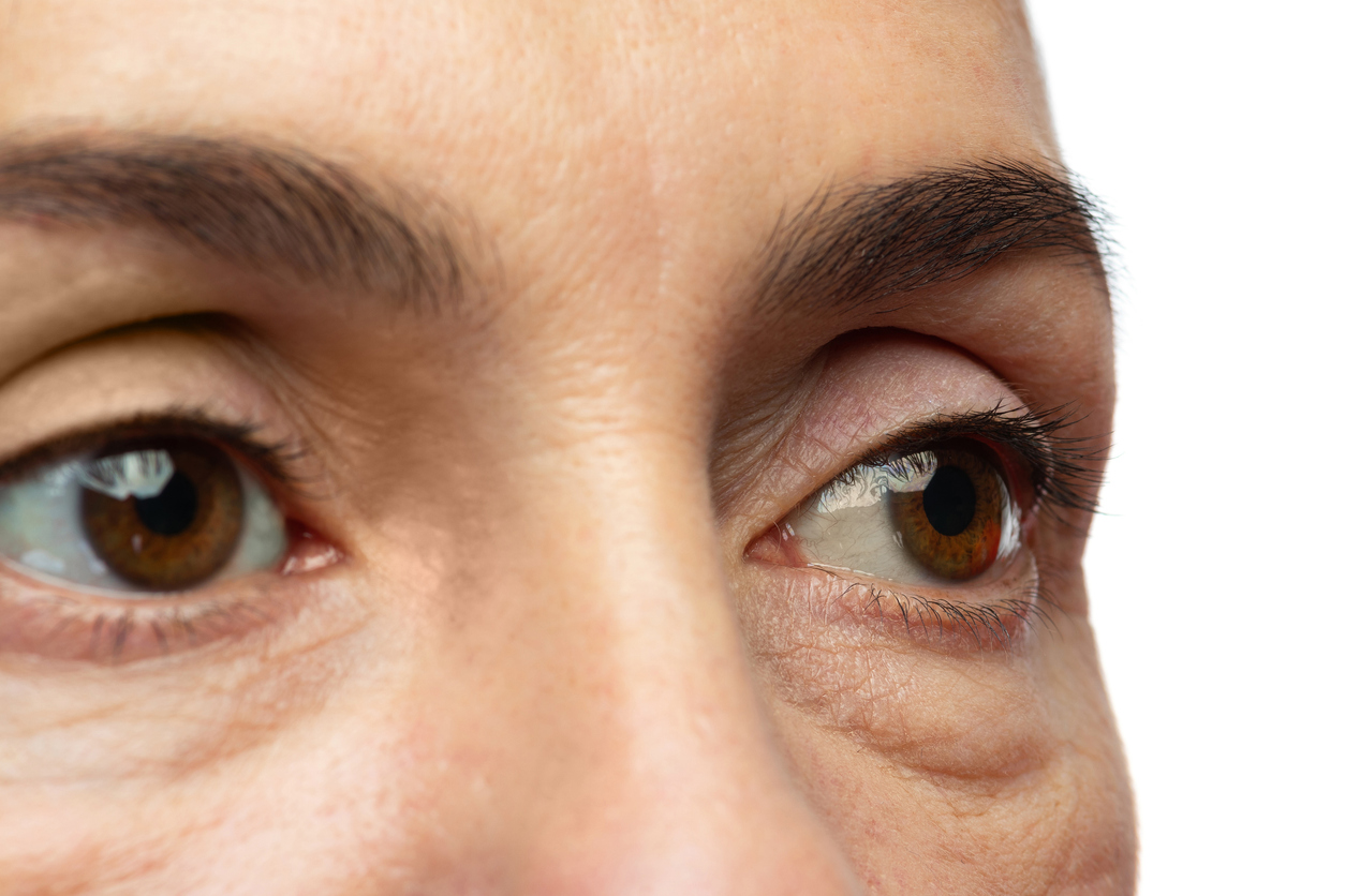 Common eye problem is puffiness which may be caused by tear trough deformity as we get older