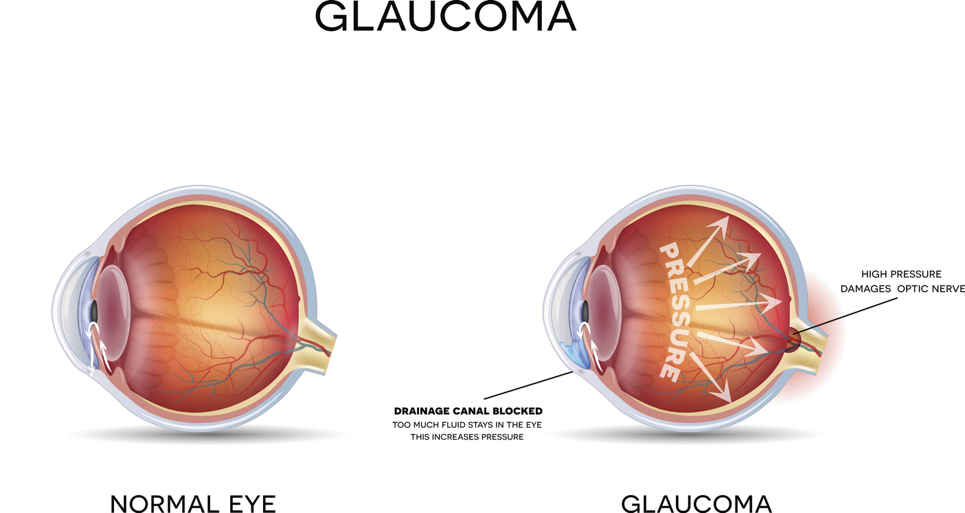 Glaucoma is another common eye problem for older people. Detailed anatomy of Glaucoma and healthy eye.