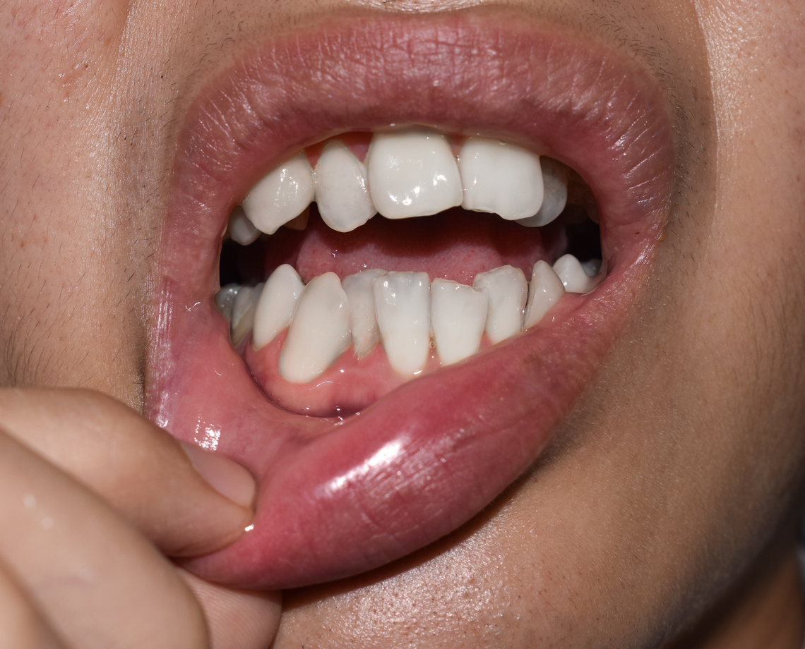 Stacked or overlapping white teeth. Also called crowded teeth.