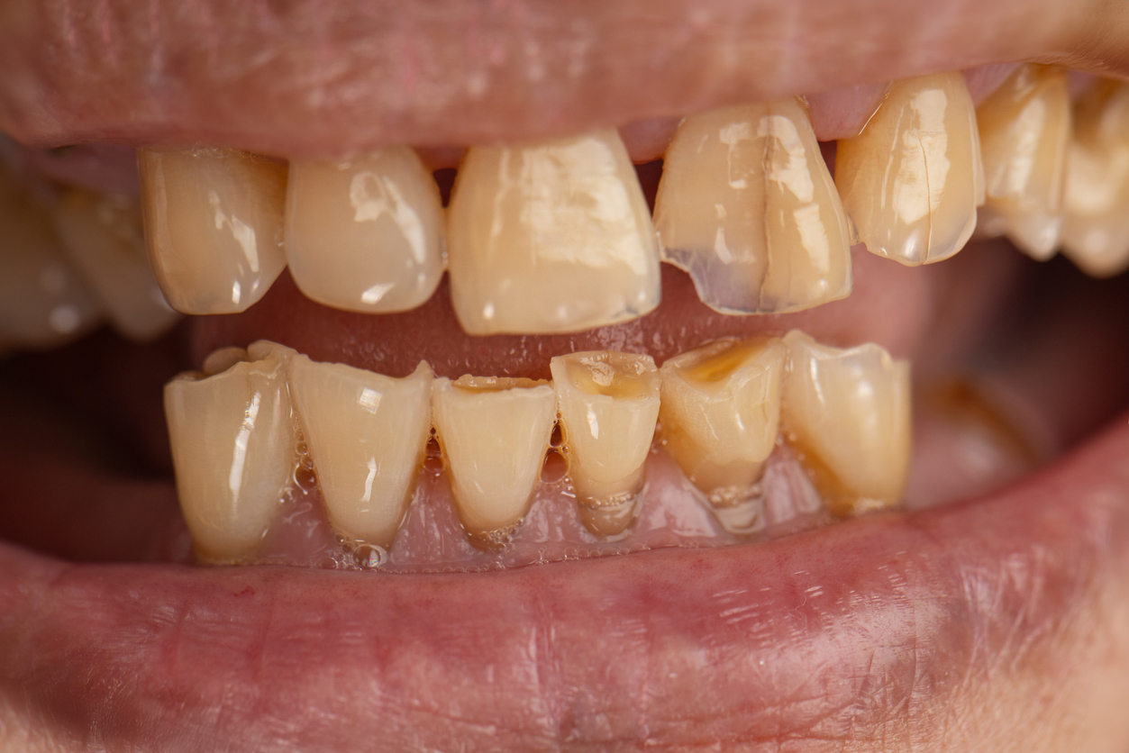 Attrition tooth due to interaction with other teeth in elderly woman.